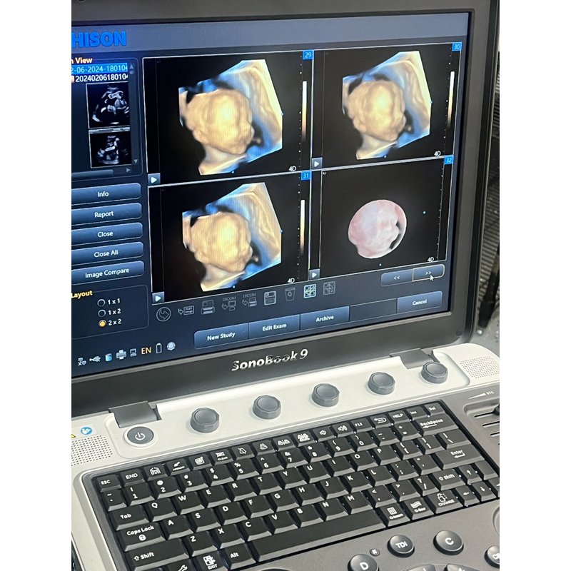 Chison SonoBook9 4D Ultrasound w/4D Convex Probe, Abdominal, OBGYN - Manf 2023